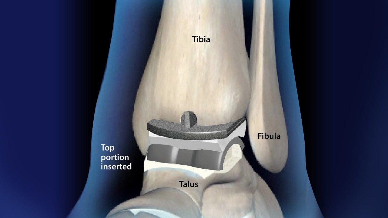 Best Ankle Replacement Doctor in Faridabad - drashutoshshrivastava.com